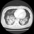 Acute pulmonary edema on CT (Radiopaedia 33582-34672 Axial lung window 35).jpg