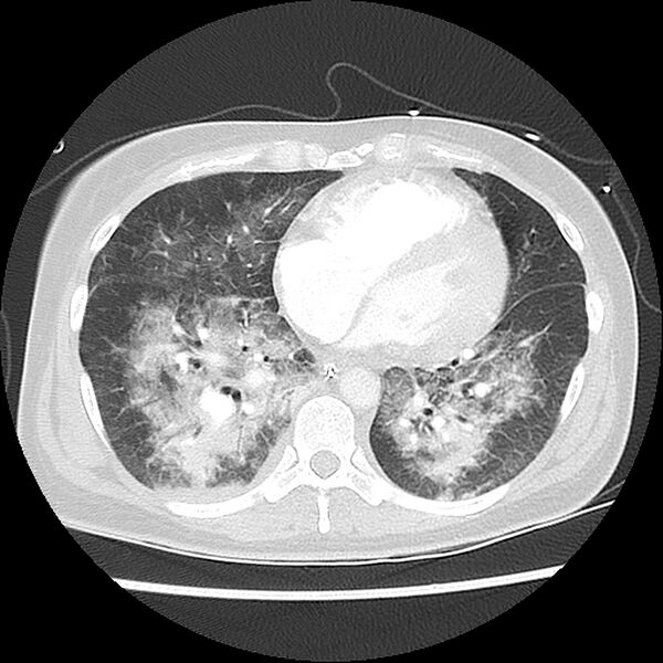 File:Acute pulmonary edema on CT (Radiopaedia 33582-34672 Axial lung window 35).jpg