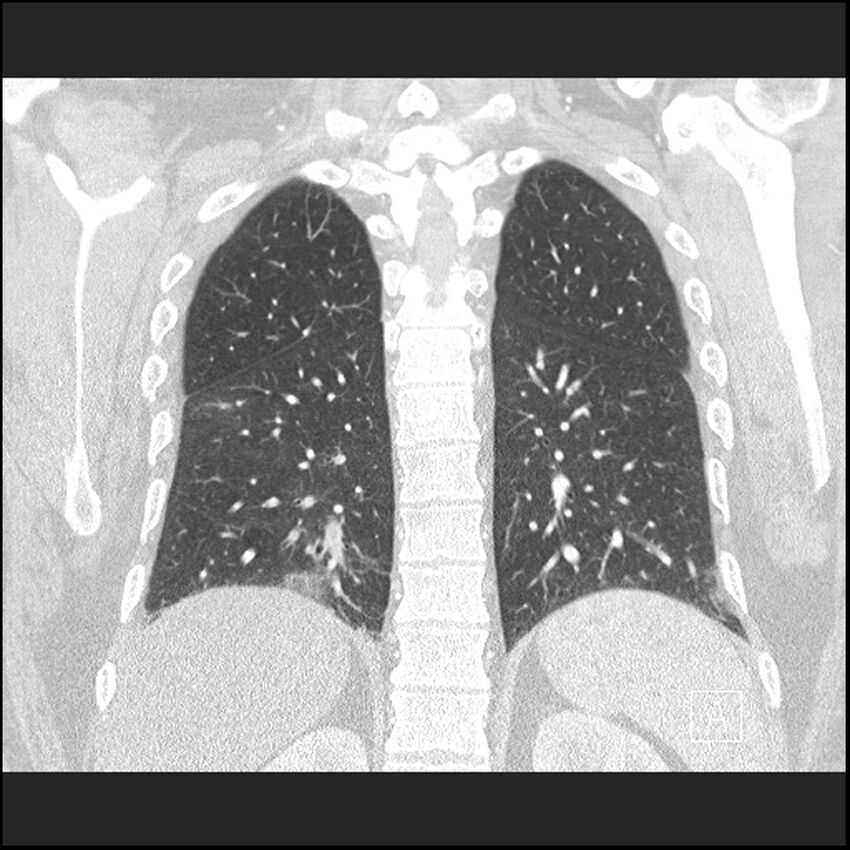 Acute pulmonary embolism with pulmonary infarct (Radiopaedia 73062-83768 Coronal lung window 56).jpg