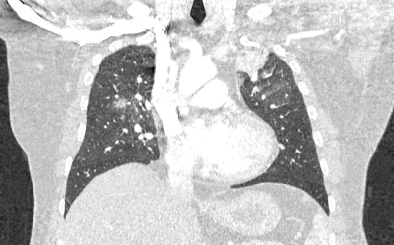 File:Acute pulmonary embolism with pulmonary infarcts (Radiopaedia 77688-89908 Coronal lung window 37).jpg