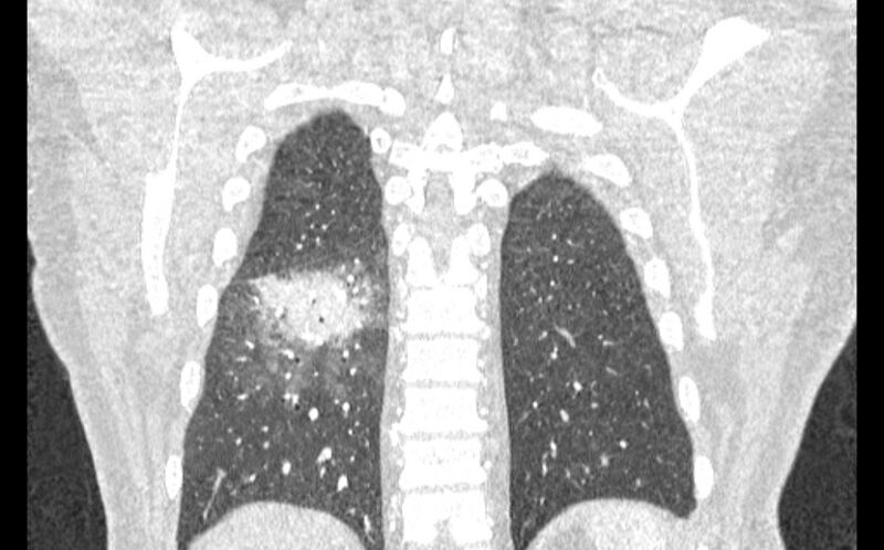 File:Acute pulmonary embolism with pulmonary infarcts (Radiopaedia 77688-89908 Coronal lung window 85).jpg