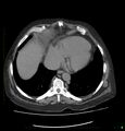 Acute renal failure post IV contrast injection- CT findings (Radiopaedia 47815-52559 Axial C+ portal venous phase 8).jpg