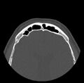 Acute sinusitis (Radiopaedia 23161-23215 Axial bone window 71).jpg