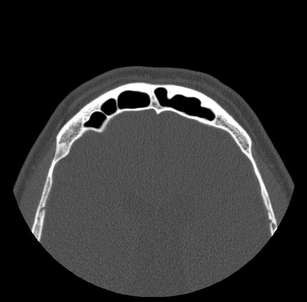 File:Acute sinusitis (Radiopaedia 23161-23215 Axial bone window 71).jpg