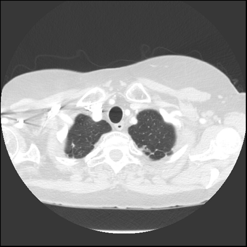 Adenocarcinoma of the lung (Radiopaedia 41015-43755 Axial lung window 13).jpg