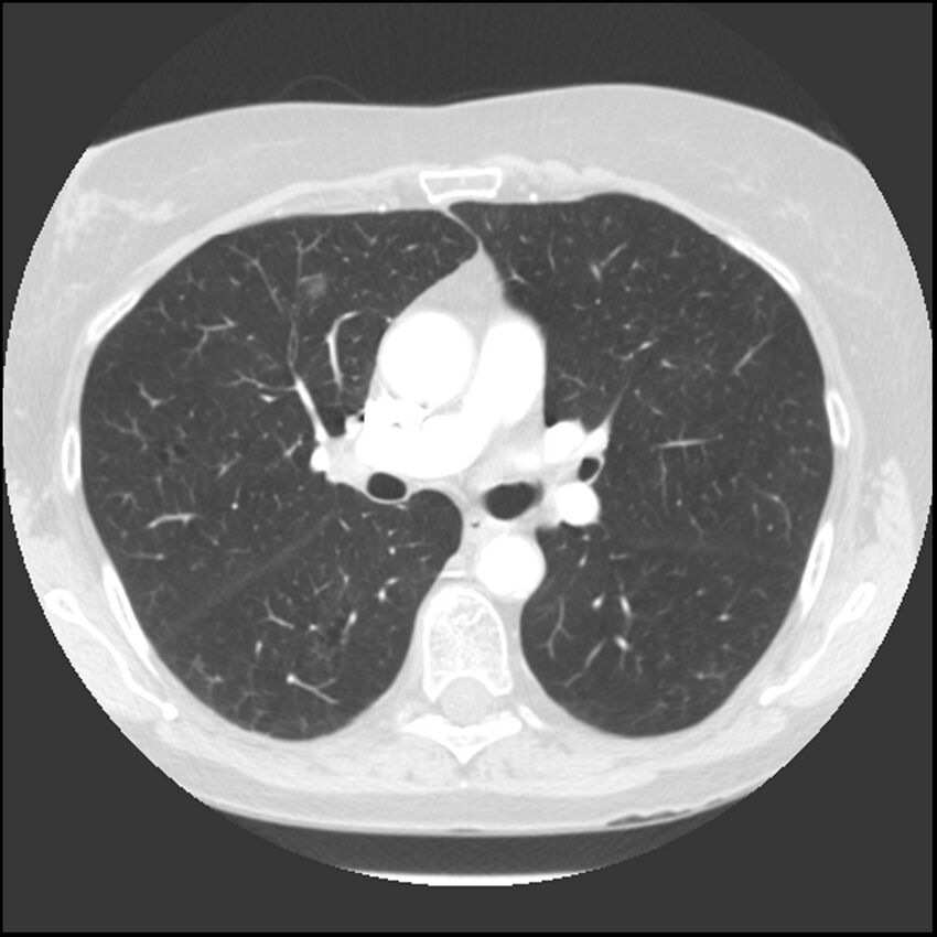 Adenocarcinoma of the lung (Radiopaedia 41015-43755 Axial lung window 53).jpg