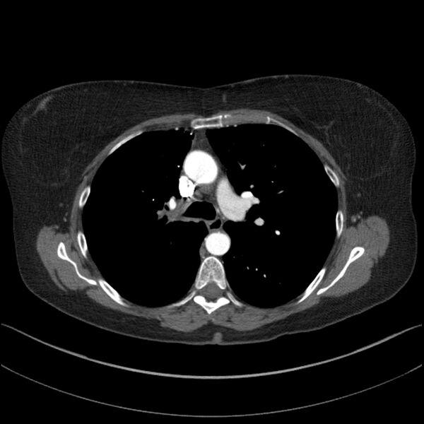 File:Adenocarcinoma of the lung (Radiopaedia 44205-47803 Axial C+ portal venous phase 33).jpg