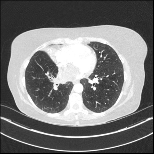 File:Adenocarcinoma of the lung (Radiopaedia 44205-47803 Axial lung window 57).jpg