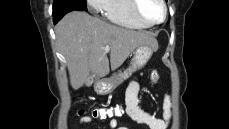 File:Adenomyomatosis of the gallbladder (Radiopaedia 12142-12483 Coronal C+ arterial phase 9).jpg