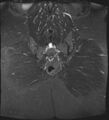 Adnexal multilocular cyst (O-RADS US 3- O-RADS MRI 3) (Radiopaedia 87426-103754 Coronal T2 fat sat 30).jpg