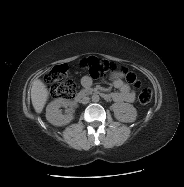 File:Adrenal cortical carcinoma with IVC invasion and thrombosis (Radiopaedia 34307-35597 Axial non-contrast 27).jpg