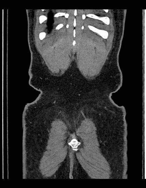 File:Adrenal myelolipoma - bilateral (Radiopaedia 74805-85810 Coronal C+ portal venous phase 51).jpg