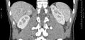 Adrenal pheochromocytoma (Radiopaedia 35133-36726 Coronal C+ portal venous phase 6).jpg