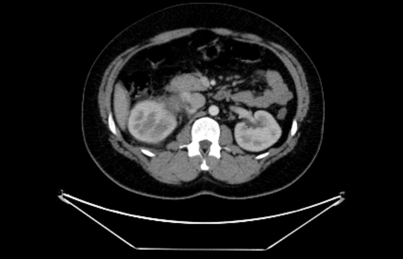 File:Adrenocortical carcinoma (Radiopaedia 80134-93438 Axial C+ portal venous phase 56).jpg