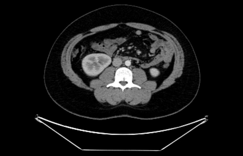 Adrenocortical carcinoma (Radiopaedia 80134-93438 Axial C+ portal venous phase 68).jpg