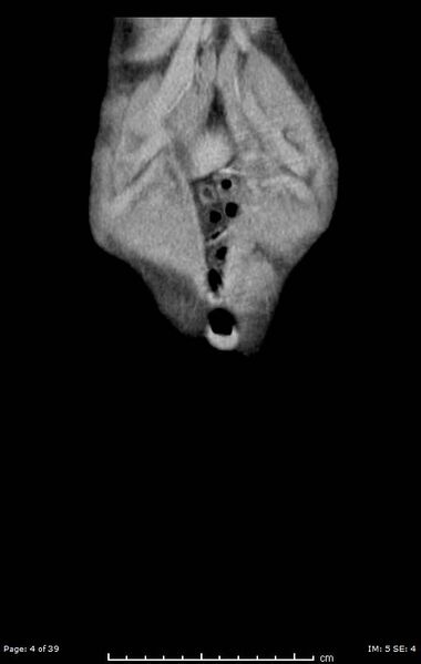 File:Agenesis of the gallbladder (Radiopaedia 55454-61905 A 4).jpg