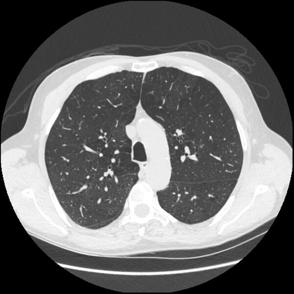 File:Alpha-1-antitrypsin deficiency (Radiopaedia 40993-43722 Axial lung window 72).jpg