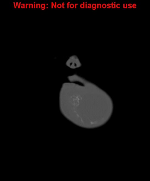 File:Ameloblastoma (Radiopaedia 33126-34164 Coronal bone window 3).jpg