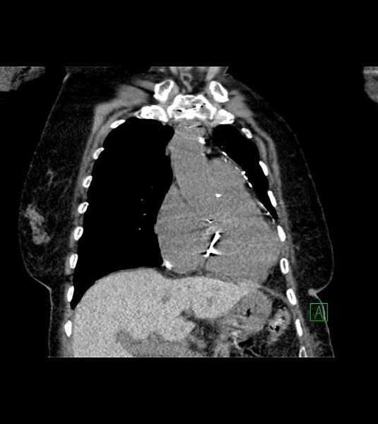 File:Amiodarone deposition in the liver (Radiopaedia 77587-89780 Coronal non-contrast 28).jpg