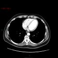 Ampullary carcinoma (Radiopaedia 56396-63056 B 6).jpg