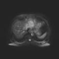 Ampullary tumor (Radiopaedia 27294-27479 T2 SPAIR 18).jpg