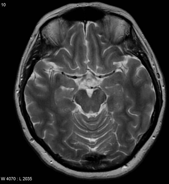 File:Amyotrophic lateral sclerosis (Radiopaedia 5373-7134 Axial T2 10).jpg