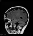 Amyotrophic lateral sclerosis (Radiopaedia 5373-7134 Sagittal FLAIR 21).jpg
