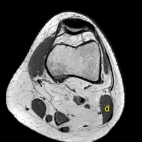 File:Anatomy Quiz (MRI knee) (Radiopaedia 43478-46866 A 5).jpeg