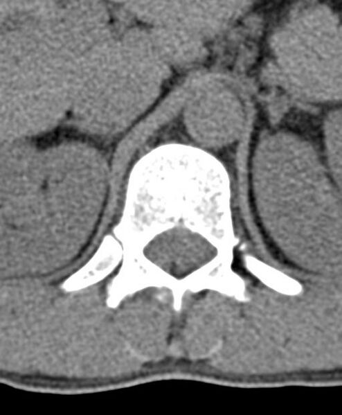 File:Aneurysmal bone cyst T11 (Radiopaedia 29294-29721 Axial non-contrast 53).jpg