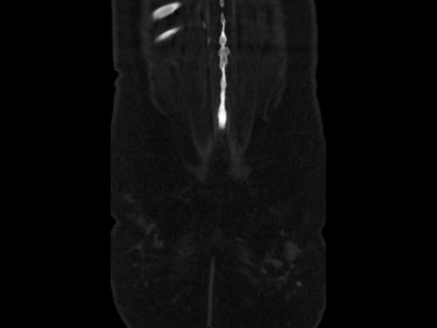 Ankylosing spondylitis (Radiopaedia 44609-48357 Coronal bone window 106).jpg