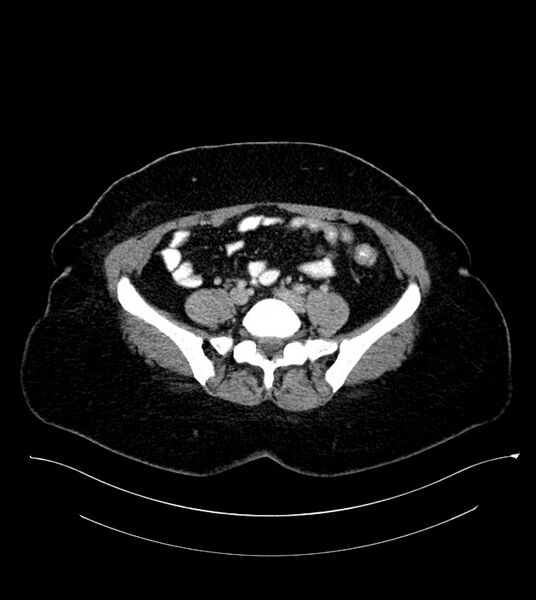 File:Anterior abdominal wall CSF pseudocyst (CSFoma) (Radiopaedia 79453-92571 A 64).jpg