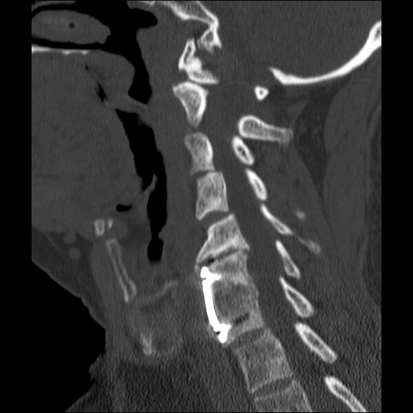 File:Anterior cervical postdiscectomy arthrodesis (Radiopaedia 32678-33646 Sagittal bone window 46).jpg