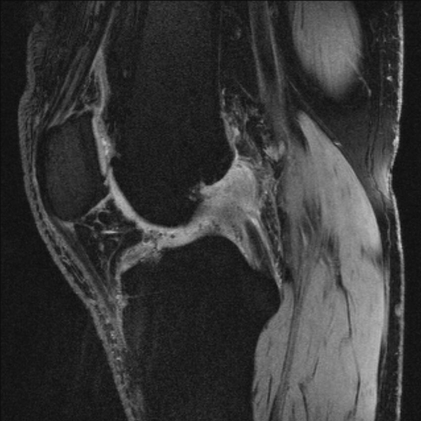 Anterior cruciate ligament mucoid degeneration (Radiopaedia 68400-77933 Sagittal 34).jpg