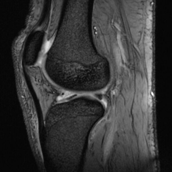 File:Anterior cruciate ligament tear - ramp lesion (Radiopaedia 71883-82322 Sagittal T2 fat sat 10).jpg