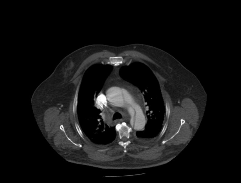 File:Aortic dissection (Radiopaedia 28802-29105 A 10).jpg