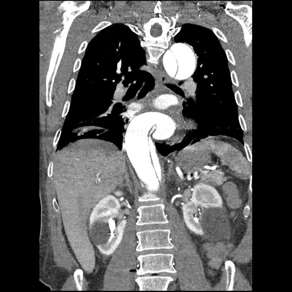 File:Aortic dissection - DeBakey Type I-Stanford A (Radiopaedia 79863-93115 B 24).jpg
