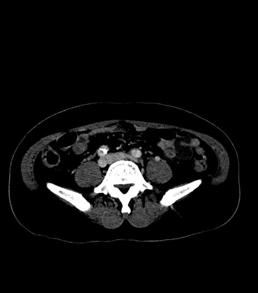 File:Aortic dissection with renal ischemia (Radiopaedia 76573-88338 B 49).jpg
