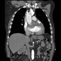 Aortic dissection with rupture into pericardium (Radiopaedia 12384-12647 B 17).jpg