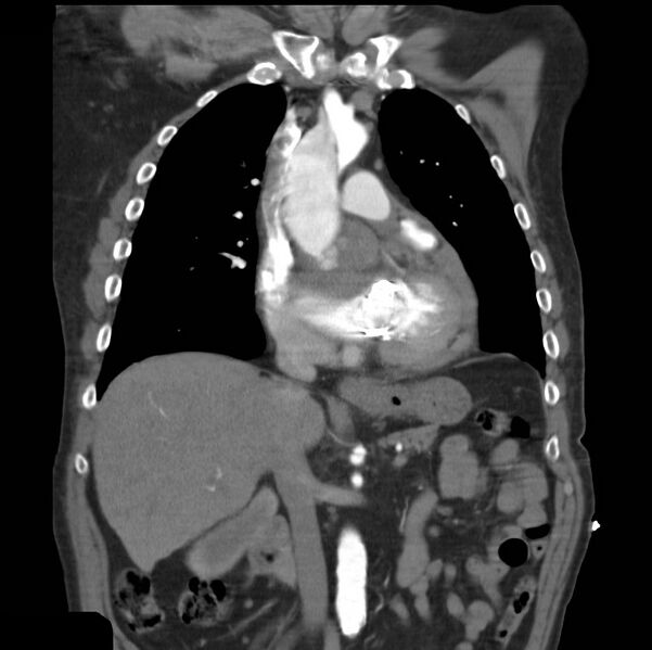 File:Aortic dissection with rupture into pericardium (Radiopaedia 12384-12647 B 17).jpg