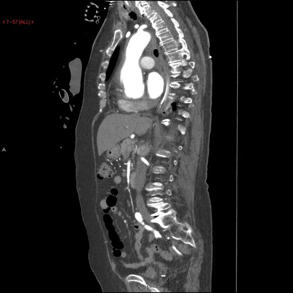 File:Aortic intramural hematoma (Radiopaedia 27746-28001 C 26).jpg