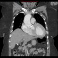 Aortic valve stenosis (Radiopaedia 14480-14423 A 5).jpg