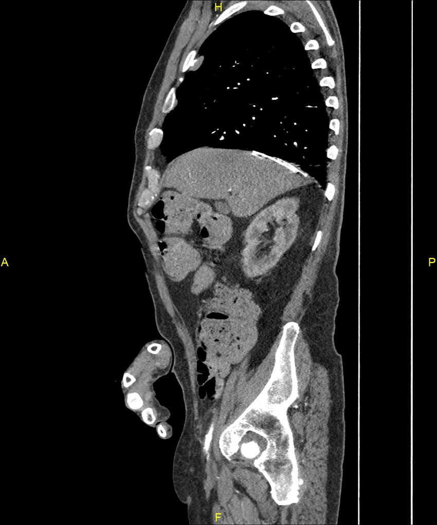 Aortoenteric fistula (Radiopaedia 84308-99603 C 97).jpg