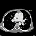 Aortopulmonary window, interrupted aortic arch and large PDA giving the descending aorta (Radiopaedia 35573-37077 C 1).jpg