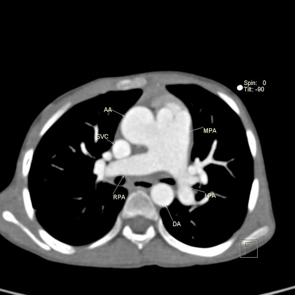 File:Aortopulmonary window, interrupted aortic arch and large PDA giving the descending aorta (Radiopaedia 35573-37077 C 1).jpg