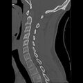 Apical pneumothorax on cervical spine CT (Radiopaedia 45343-49368 Sagittal bone window 13).jpg