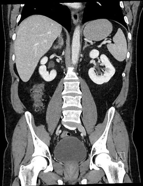 File:Appendiceal diverticulitis (Radiopaedia 61802-69916 B 86).jpg