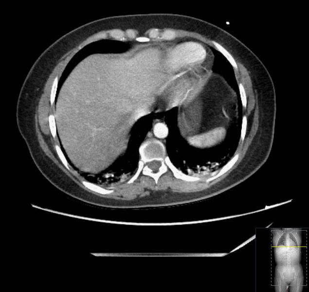 File:Appendicitis (CT angiogram) (Radiopaedia 154713-127660 Axial 174).jpg