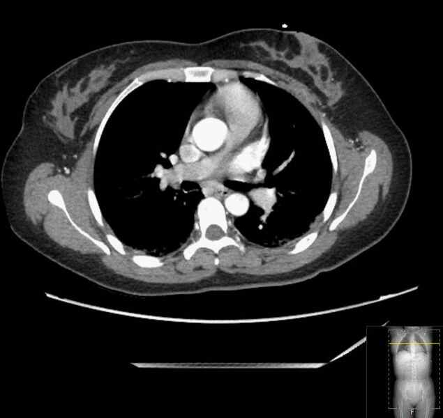 File:Appendicitis (CT angiogram) (Radiopaedia 154713-127660 Axial 205).jpg