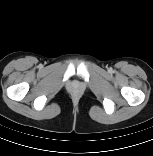 File:Appendicitis and incidental bicornuate uterus (Radiopaedia 22833-22853 Axial C+ delayed 43).jpg