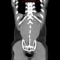 Appendicitis and renal cell carcinoma (Radiopaedia 17063-16760 B 27).jpg